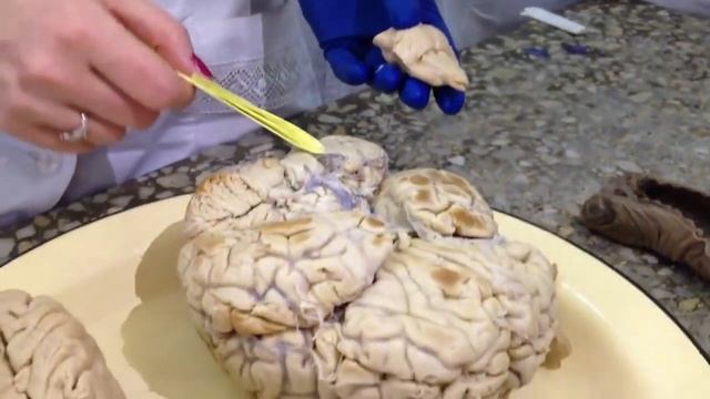 Продолговатый мозг. Medulla oblongata. Задний мозг. Metencephalon. смотреть онлайн