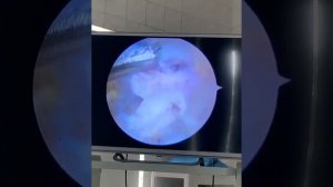 Удаление пяточной шпоры. ЧУЗ КБ "РЖД-Медицина"