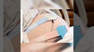 тема на СРС: точки выслушивание сердцебиение плода