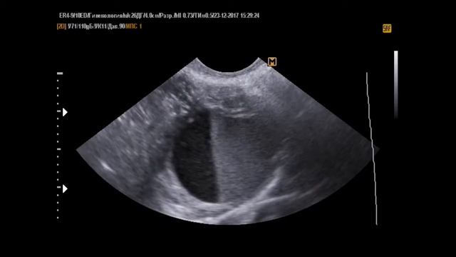 Киста яичника день ночь (23-12-17) смотреть онлайн