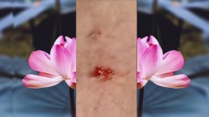 Выдавливание чёрных точек НОВОЕ! Удаление чёрных точек за ухом. p25