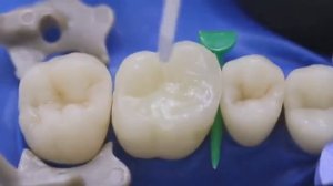 Препарирование кариозной полости