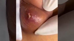 Жуткий прищь на ухе