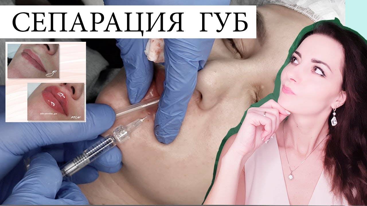 Сепарация УВЕЛИЧЕНИЕ ГУБ 3 вкола /техника  губы Анджелины Джоли/ БЬЮТИФИКАЦИЯ ГУБ