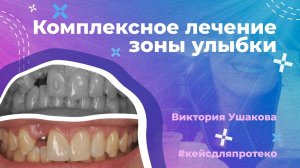 Этап КОМПЛЕКСНОГО ЛЕЧЕНИЯ зоны улыбки