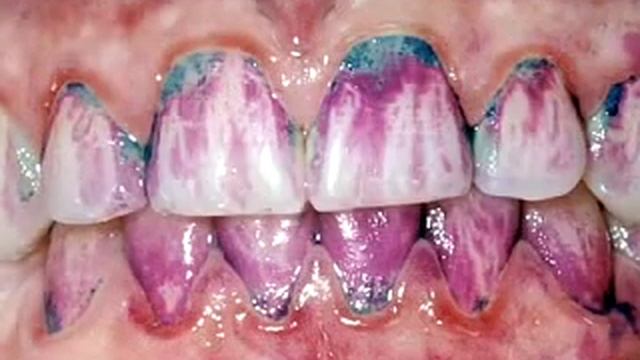 Ультразвуковая чистка зубов смотреть онлайн