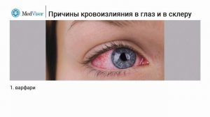 Причины кровоизлияния в глаз и в склеру
