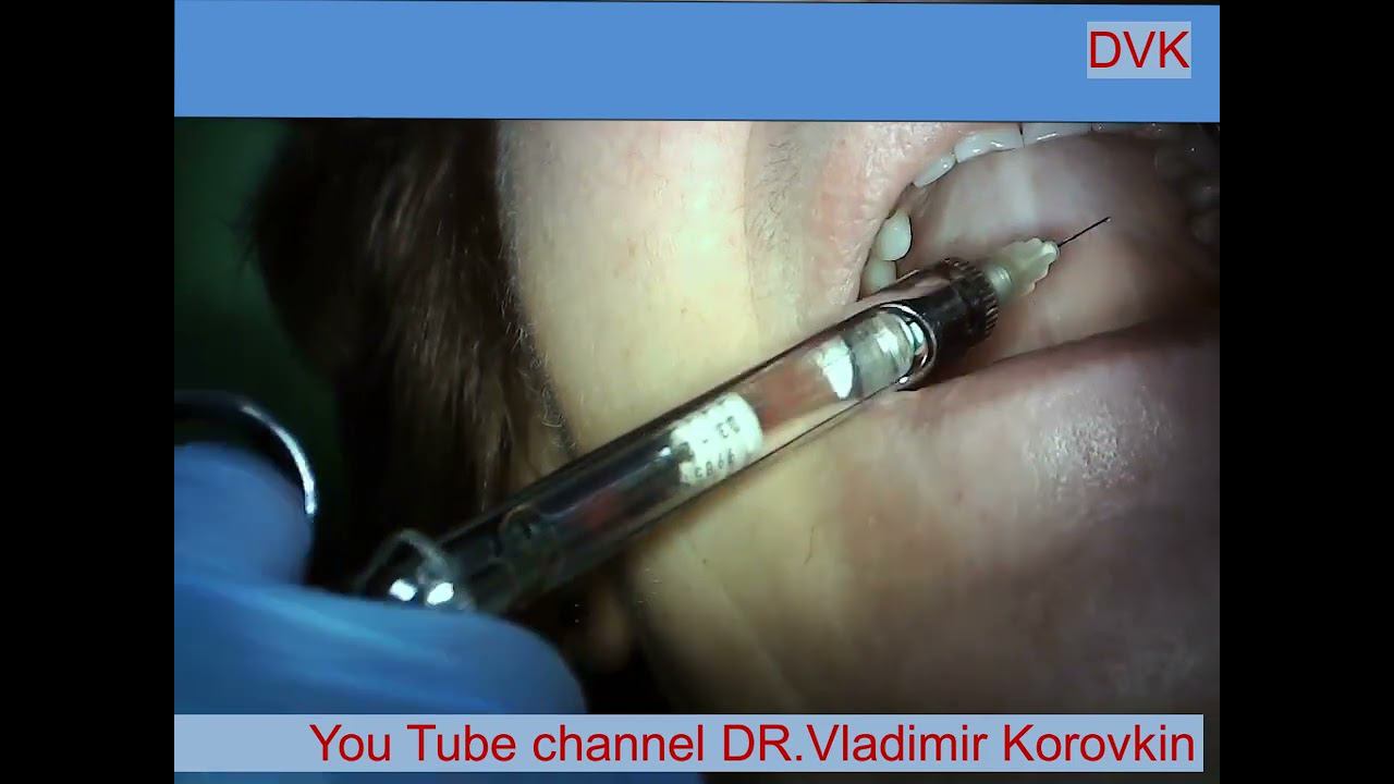 Infiltration Anesthesia for treatment 26 tooth.