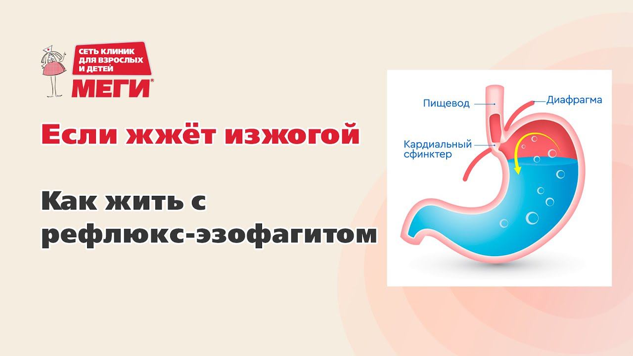 Как избавиться от изжоги?