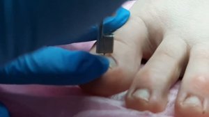 Установка корректирующей системы Podofix - Подолог Елена Баскова