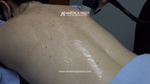 Depilación de espalda completa con Soprano Titanium | Centro Dermatológico América Pasos