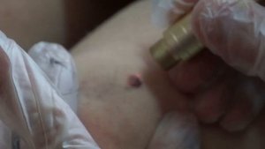 Лазерное Удаление Папилломы на Колене