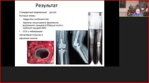 Сложные вопросы первичного эндопротезирования коленного сустава 16-03-2022 .mp4