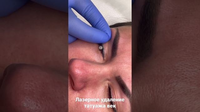 Безопасное лазерное удаление татуажа век с использованием защитных склеральных шильд