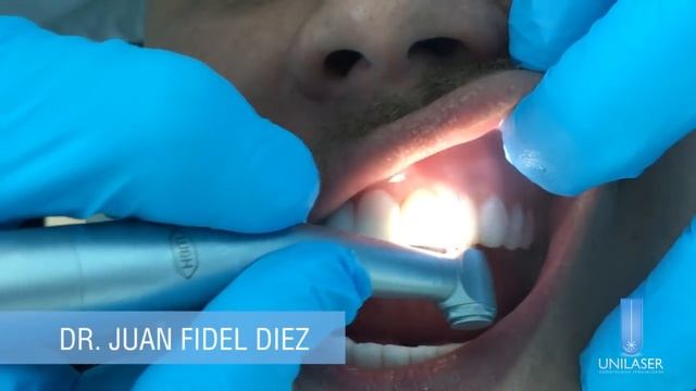 Unilaser | Diseño de Sonrisa paso a paso смотреть онлайн