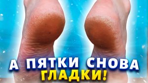 Всё лето хожу в открытой обуви и не стесняюсь. Мои пяточки всегда как у младенца, без натоптышей.