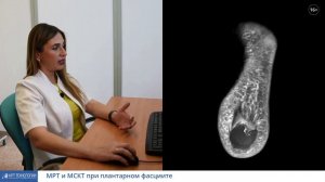 Томография стопы. Плантарный фасциит