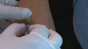 Внутривенная инъекция Инфузия Капельница