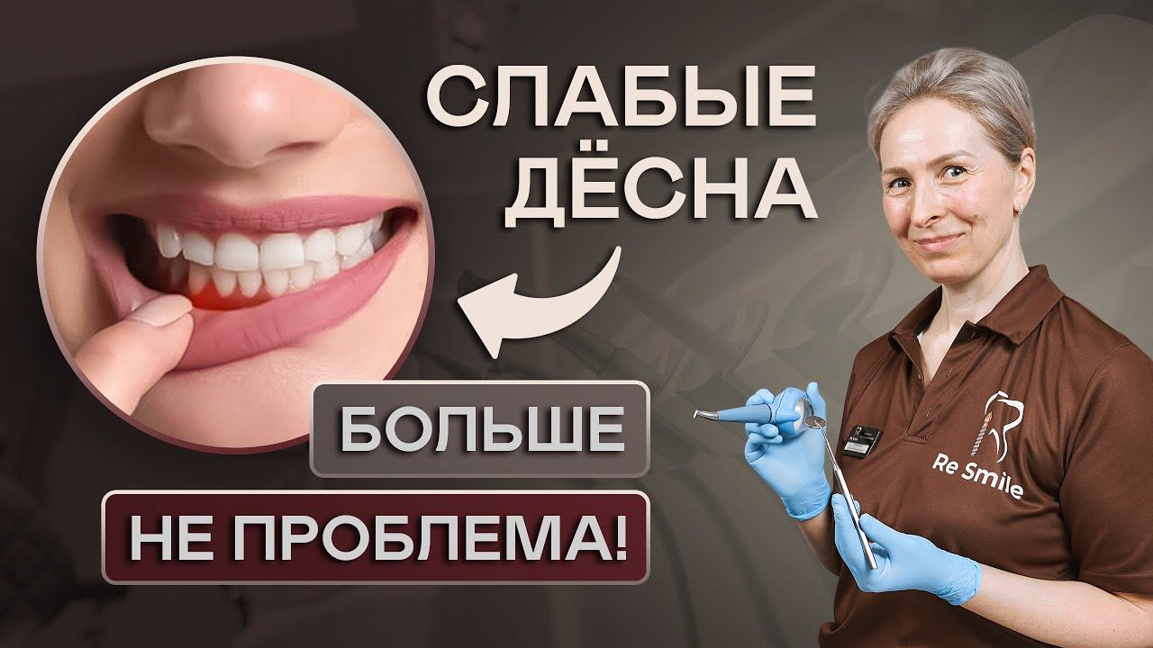 СЛАБЫЕ ДЁСНЫ - БОЛЬШЕ НЕ ПРОБЛЕМА! Причины и методы лечения  КРОВОТОЧИВОСТИ ДЁСЕН.