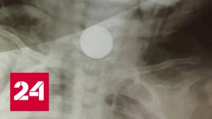 В Челябинске ребенок едва не задохнулся, проглотив батарейку - Россия 24