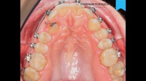 Постановка в зубной ряд небно дистопированных клыков при помощи брекетов Damon Q