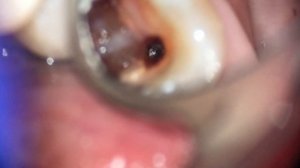 Извлечение инструмента из корневого канала зуба под микроскопом