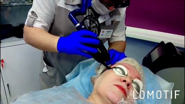 Лазерная шлифовка в клинике Асклепион смотреть онлайн