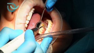 Профессиональная чистка полости рта