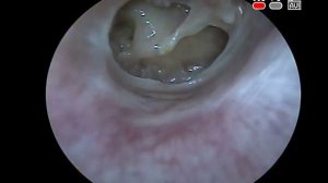 Эндоскопия уха: мезотимпанит, тотальная перфорация барабанной перепонки