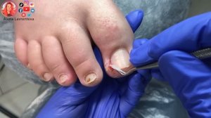 Вросший ноготь и влажная стопа / Установка тампонады