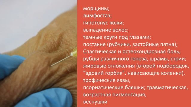 КАРБОКСИТЕРАПИЯ