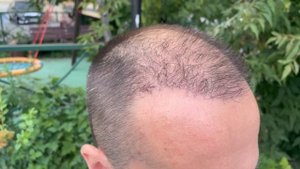 Пересадка волос. Четыре месяца (120 дней)