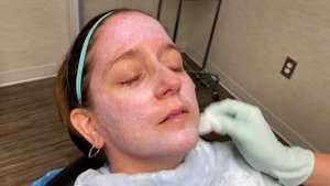 Chemical Peel 35 TCA