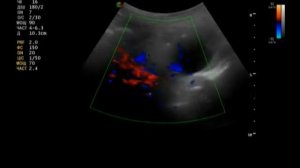 Аневризма аорты