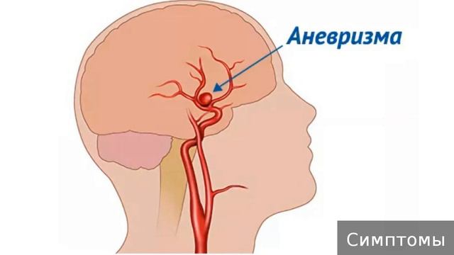 Аневризма. Как лечить аневризму. смотреть онлайн