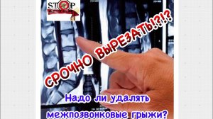 НУЖНО ЛИ УДАЛЯТЬ МЕЖПОЗВОНКОВЫЕ ГРЫЖИ? ЧТО ДЕЛАТЬ, ЕСЛИ НА МРТ ОБНАРУЖИЛИ МЕЖПОЗВОНКОВЫЕ ГРЫЖИ?