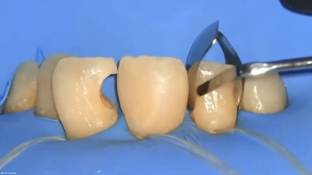Художественная реставрация фронтальных зубов?? Artistic restoration of anterior teeth??