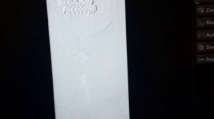 критический стеноз (функциональная окклюзия) левой позвоночной артерии