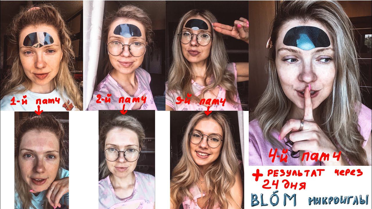 Микроигольные патчи для лба BLOM из Сколково. Самое правдивое тестирование. Мой вердикт. Beautymaker