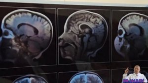 Гипоксически-ишемической энцефалопатии, асимметричной гидроцефалией