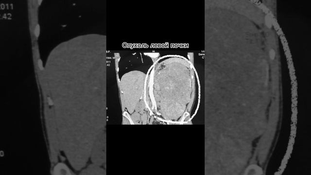 Опухоль левой почки
