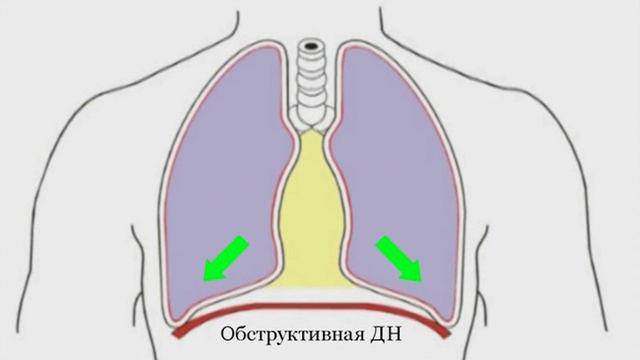 5. Дыхательная недостаточность