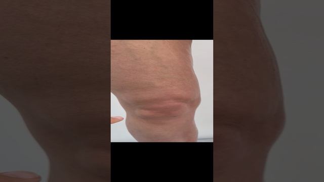 Варикоз малого таза. Поперечное плоскостопие. Флеболог Москва. Флеболог. Сосудистый хирург. Лечение смотреть онлайн