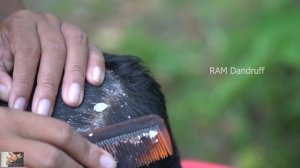 Psoriasis treatment - Dandruff Removal - Itchy Scratching - Huge Flakes, Part 245