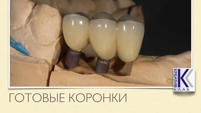 Коронка на имплант #10