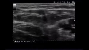 Анонс - УЗИ артерий и вен верхних конечностей