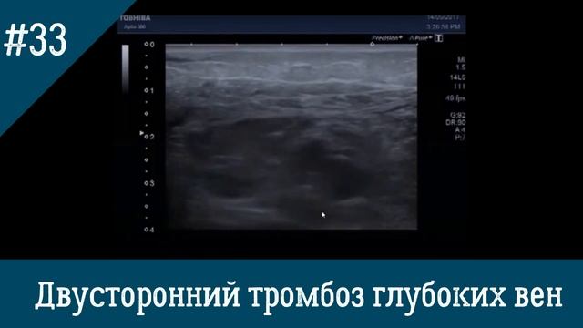 УЗИ вен. Двусторонний тромбоз глубоких вен подвздошно-бедренно-подколенно-берцового сегмента.