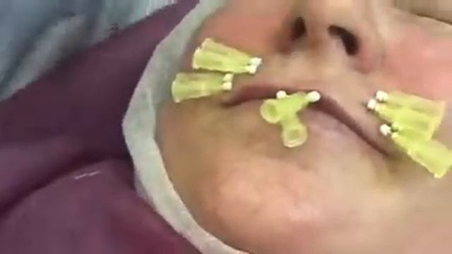 Коррекция губ . смотреть онлайн