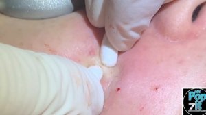 Your new Fave Extractions Part 3! Over 17 minutes of just pops. I edit out all the prep. Acne pops.