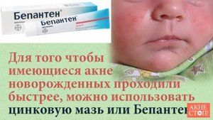 Акне новорожденных или что делать с прыщиками?